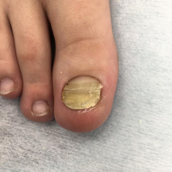 Infection with a fungus