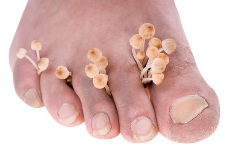 Leg fungus symptoms