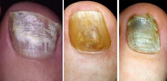In the photo, a change in the color of the nails on the legs with a fungal disease