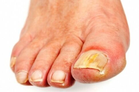The fungus first affects the nails of the first and fifth toes.