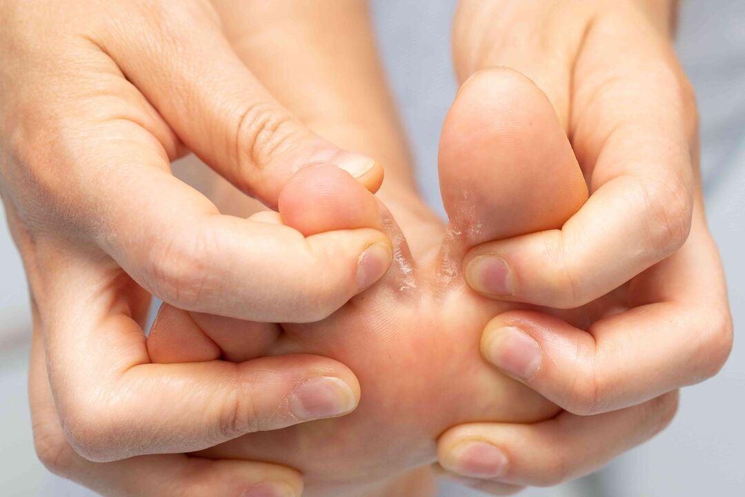 fungus between the fingers of the feet and its treatment with zxCVBNMQWERT cream